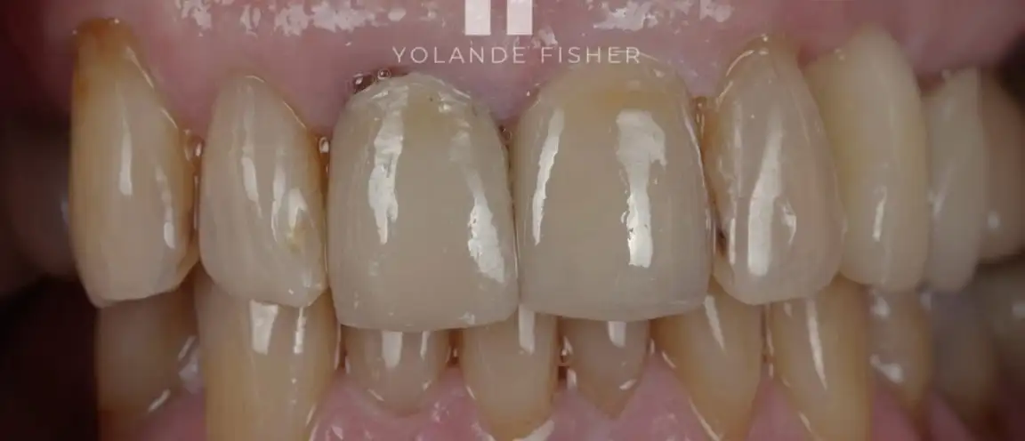 After Smile Makeover